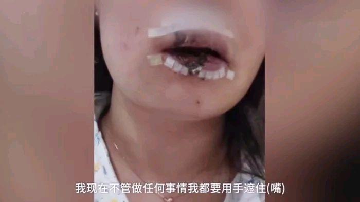 女子给朋友狗喂食，嘴唇被咬掉一半，医生：咬掉那一半找不到，已经没有办法复